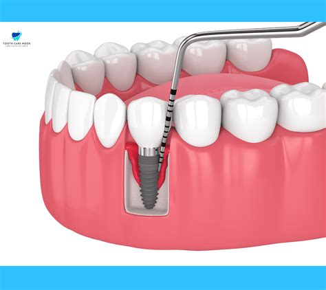 How is an implant removed
