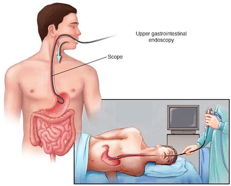 How is an upper endoscopy performed
