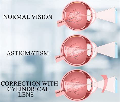 How is astigmatism treated