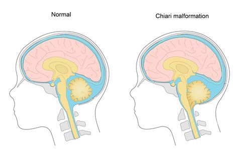 How is chiari malformation diagnosed