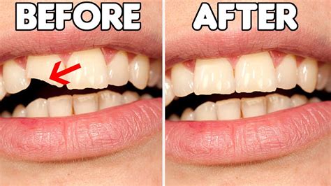 How is chipped tooth fixed