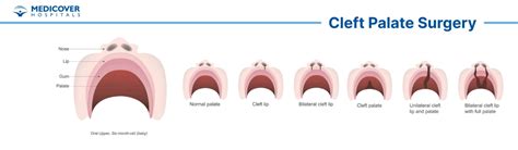 How is cleft palate surgery done
