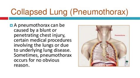 How is collapsed lung treated