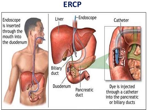 How is ercp performed