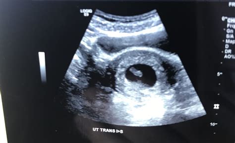 How is first ultrasound done in pregnancy