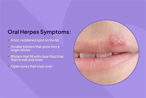 How is herpes passed on