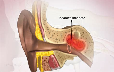 How is inner ear infection treated