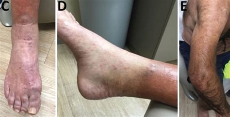 How is leprosy caught