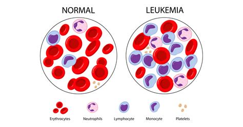 How is leukaemia diagnosed