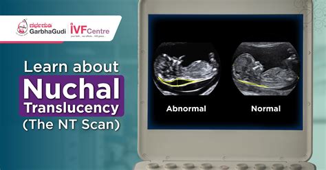 How is nuchal translucency done