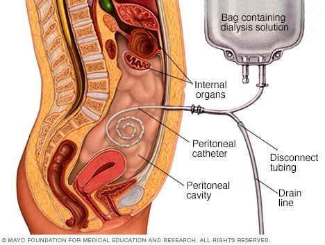 How is peritoneal dialysis done