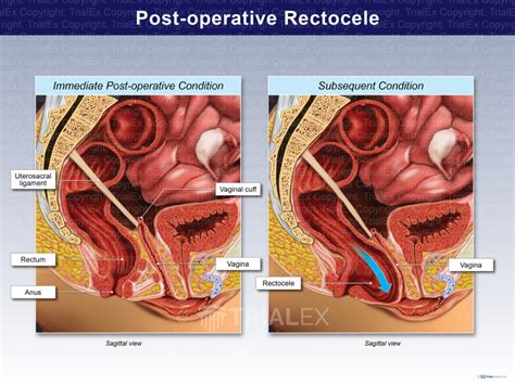How is rectocele surgery performed