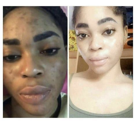 How is skin bleached