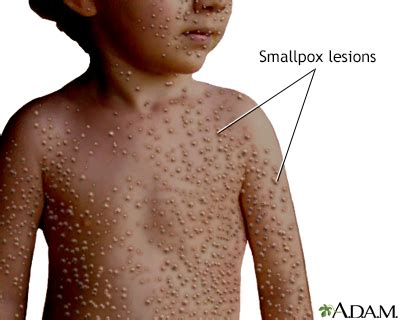 How is smallpox caused