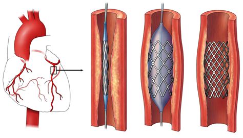 How is stent put in heart