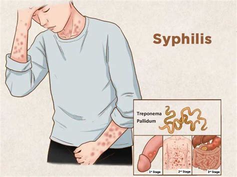 How is syphilis contracted