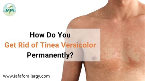 How is tinea versicolor spread