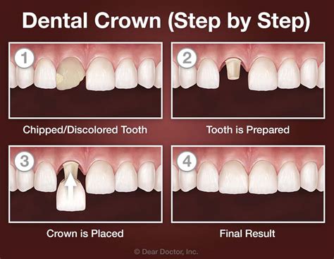 How is tooth crown done