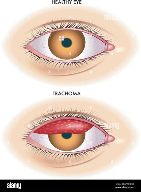 How is trachoma caused