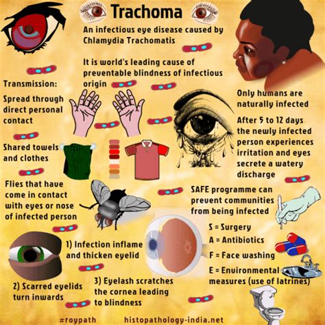 How is trachoma spread