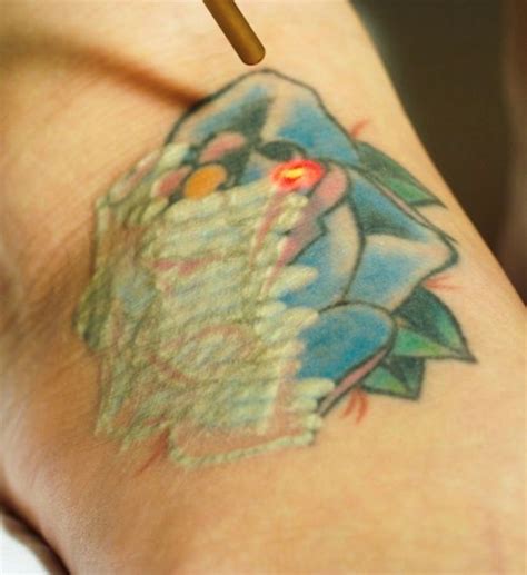 How it Works - Rethink Tattoo Removal