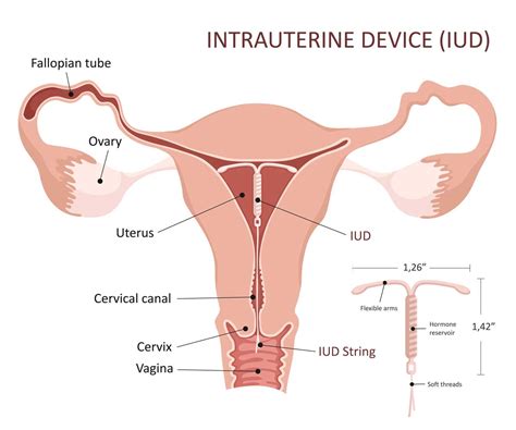 How iud is placed