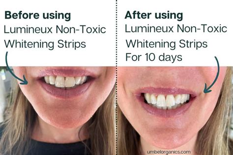 th?q=How+long+after+teeth+whitening+gel+can+I+eat