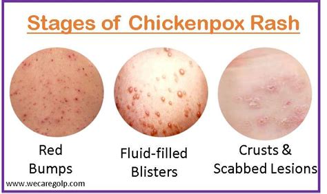 How long before chickenpox is not contagious