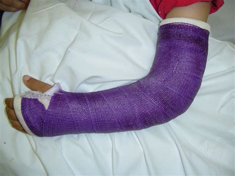 How long could my broken arm be in a cast - HealthTap