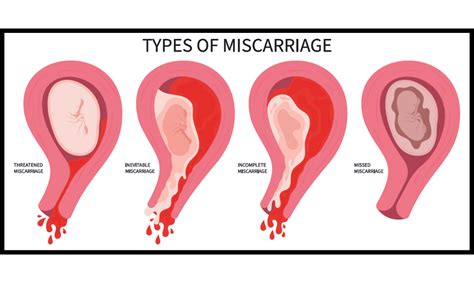 How long does a miscarriage take once bleeding starts reddit.  Understanding what implantati...