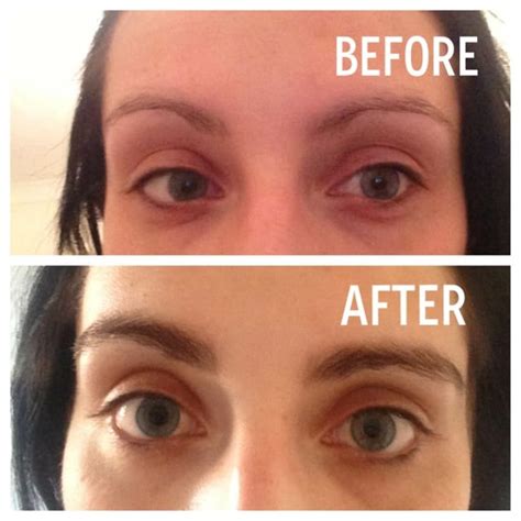 How long does it take eyebrows to grow back. If you’re wondering, “How long do eyebrow cuts take to grow back?” The regrowth time for eyebrow slits can vary but typically takes around 2 to 4 weeks. However, individual factors like hair growth rate and the depth of the slit may influence the exact duration. Patience is key in waiting for the hair to fully grow back to cover the slit. 