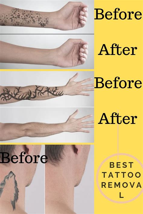 How long does it take to remove a tattoo. What to Expect: Everyone’s Tattoo Removal Progress is Unique. Good things come to those who wait. While the number of sessions required to remove a tattoo varies based on many factors, most pieces take about 10-12 visits before you see full removal. 