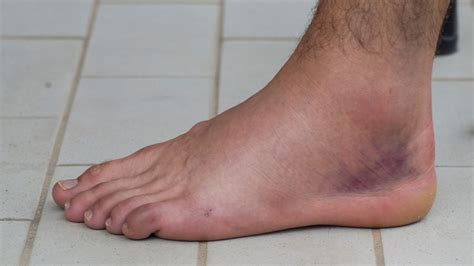 How long is a ankle sprain