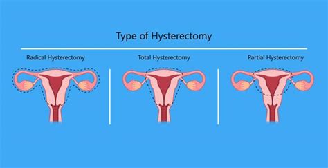 How long is a hysterectomy operation take