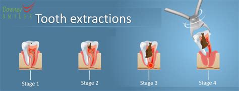 How long is a tooth extraction procedure