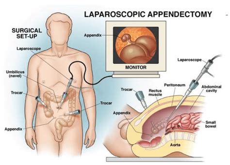 How long is appendicitis surgery take