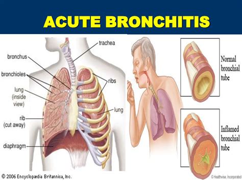 How long is bronchitis infectious