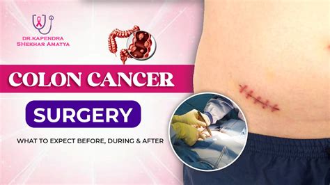 How long is colon cancer surgery. .  <a href=https://www.freepadh.com/as...