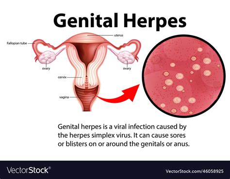 How long is genital herpes contagious