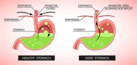 How long is gerd treatment
