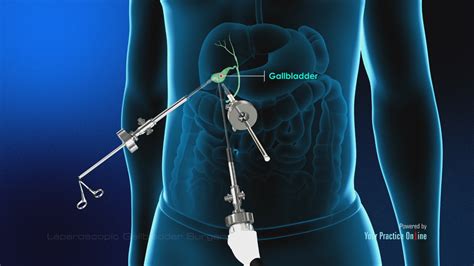 How long is laparoscopic gallbladder removal