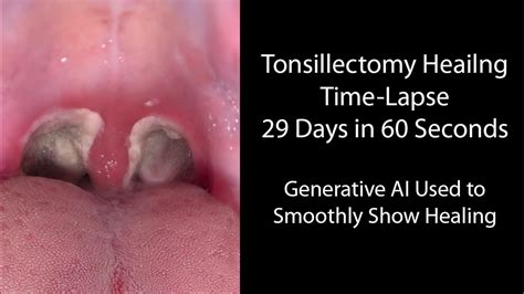 How long is recovery for tonsil surgery
