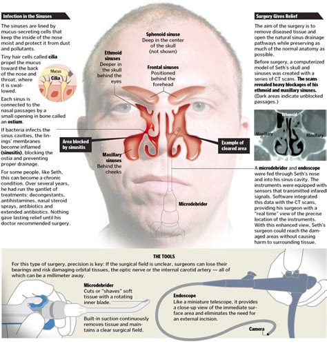 How long is sinus surgery procedure