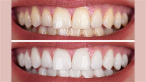 How long is teeth whitening
