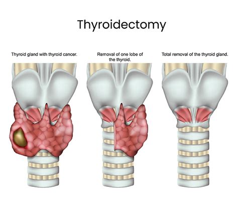 How long is thyroid nodule surgery