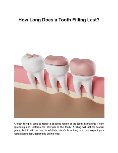 How long should a filling last