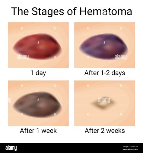 How long should a hematoma last
