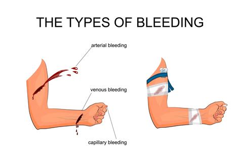 How long should a wound bleed