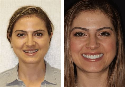 How long should front teeth be