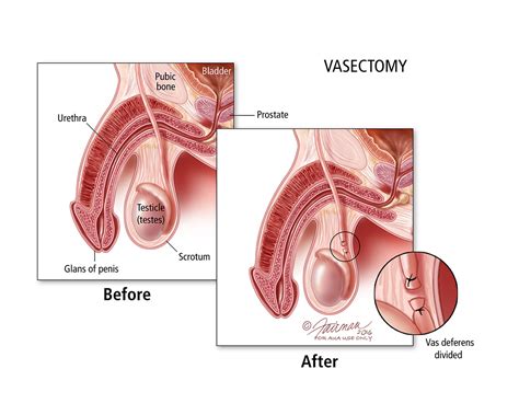 How long should i ice after vasectomy